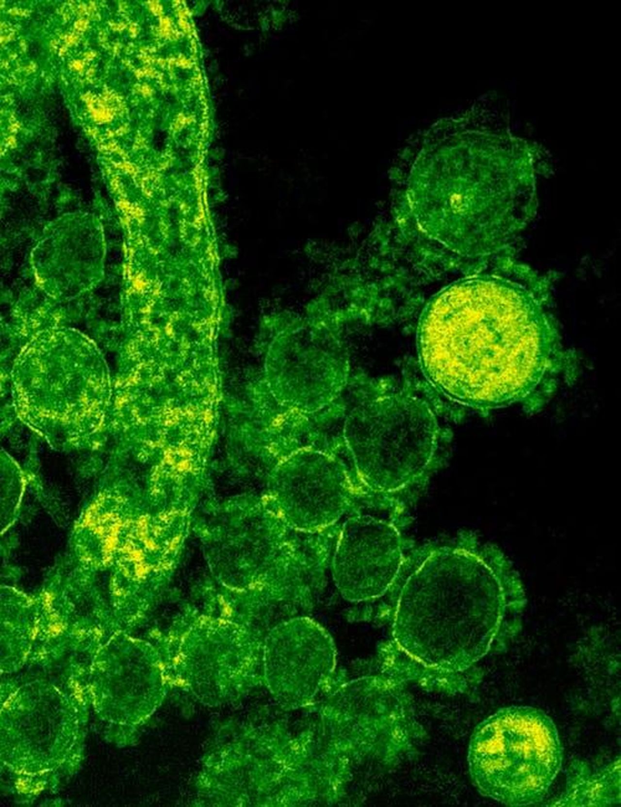 Unepidemia_di_morbillo_in_Texas_e_Nuovo_Messico_ATYVTyE5rt - Confidenze24 Source: CDC - pexels - Green-tinted microscopic image of coronavirus particles illustrating viral structures.