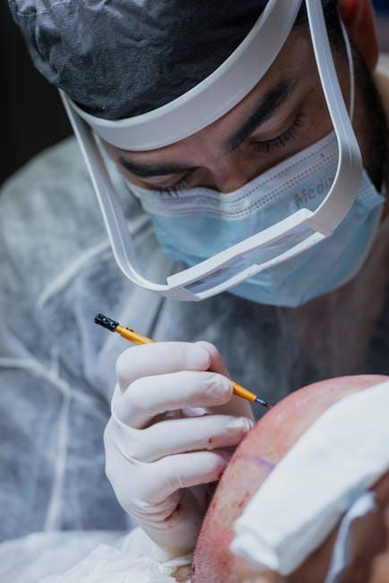 Davina_McCall_e_gli_effetti_devastanti_delloperazione_al_cervello_rjPtFP6Ljq - Confidenze24 Source: Isabella Mendes - pexels - Close-up of a neurosurgeon carefully operating on a patient in a hospital setting.
