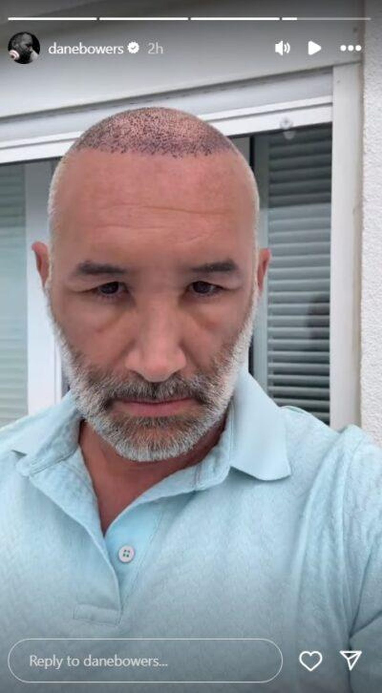 Il_nuovo_look_di_Dane_Bowers_dopo_lintervento_WfcUlDxTou - Confidenze24 Source: Instagram - - Dane Bowers mostra il viso gonfio