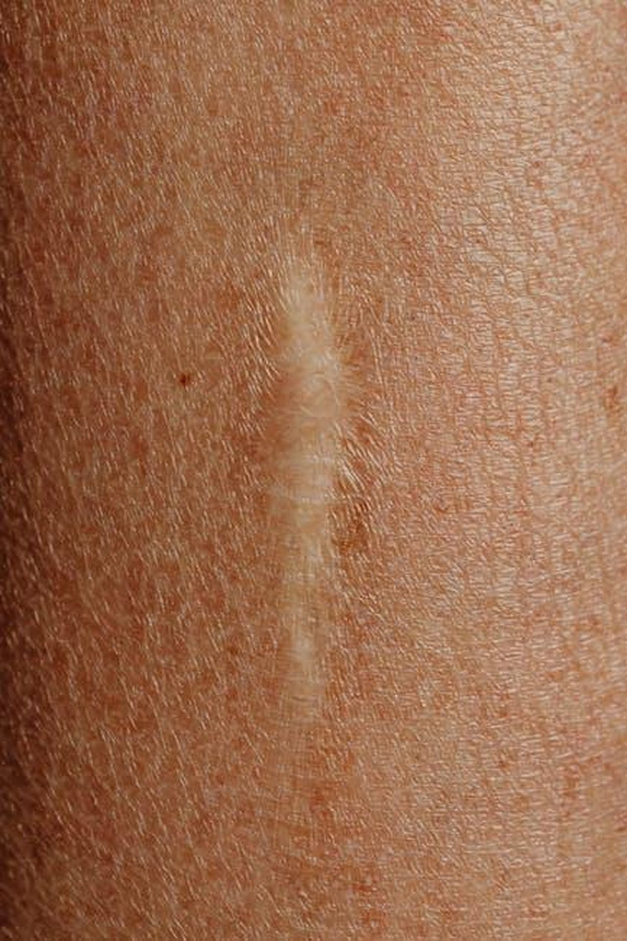 Il_processo_di_guarigione_di_DeborraLee_Furness_kGMJevWB4C - Confidenze24 Source: Photo By: Kaboompics.com - pexels - Detailed close-up image of a skin scar, highlighting texture and healing.