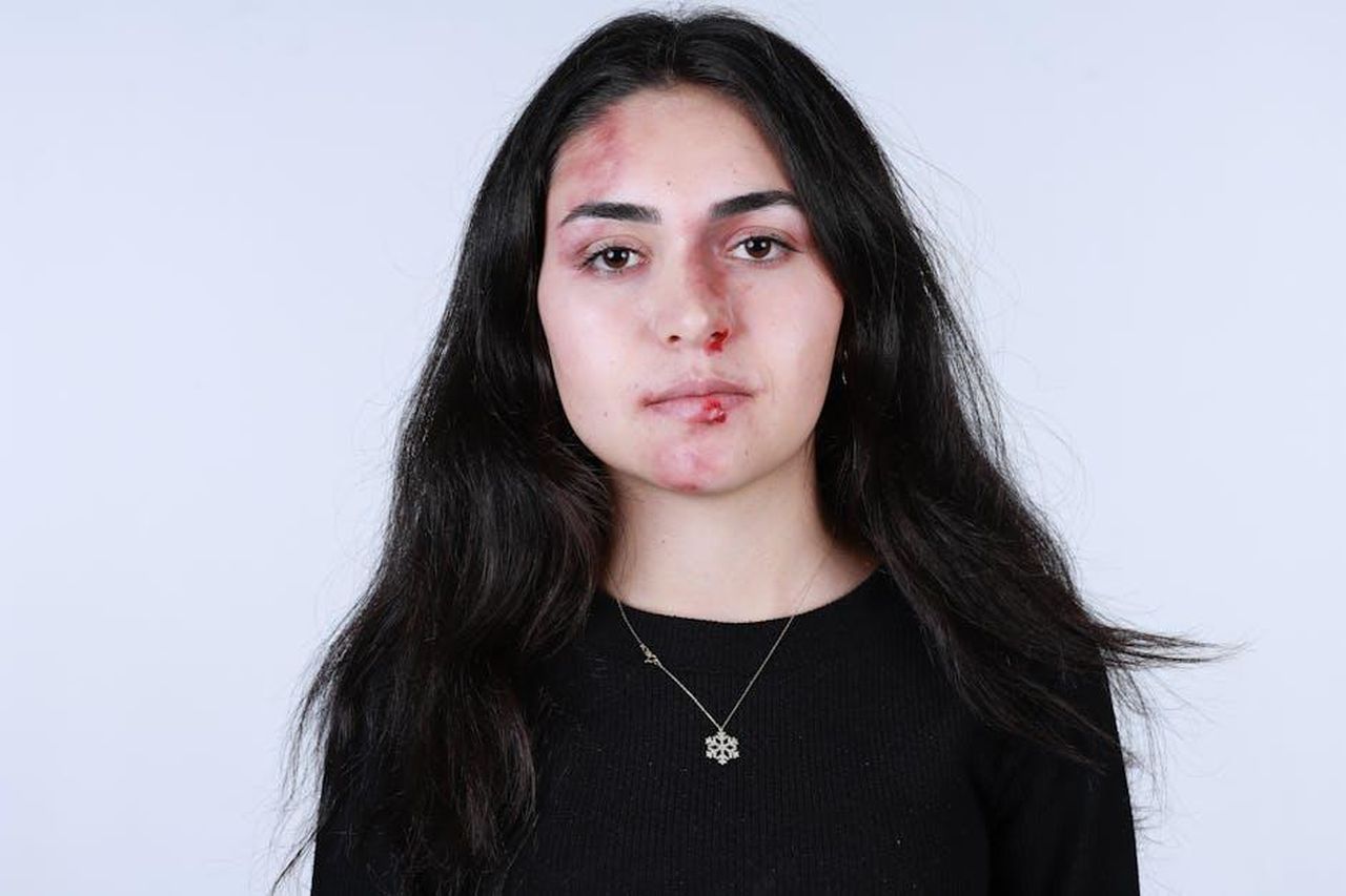 Sono_sicuramente_al_mio_peggio_in_questo_momento_VW8nNqvV88 - Confidenze24 Source: İbrahim Halil Ölmez - pexels - Close-up of woman with facial injuries.